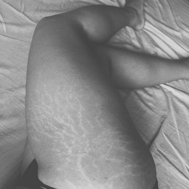 Love Your Lines Stretch Marks
